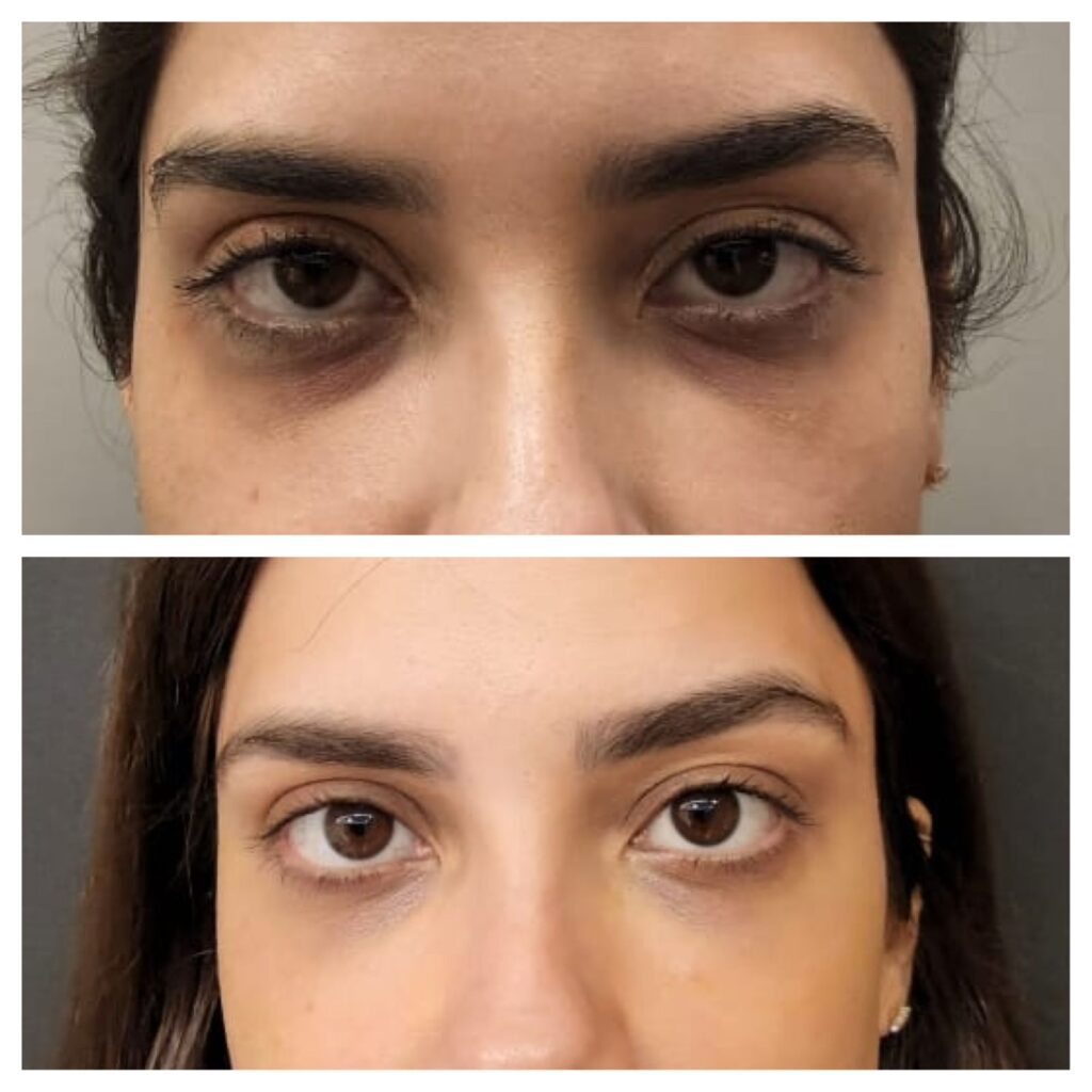 Antes e depois do tratamento na região dos olhos