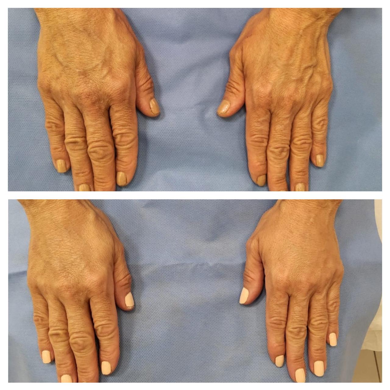 Antes e depois do protocolo Hand Glow nas mãos