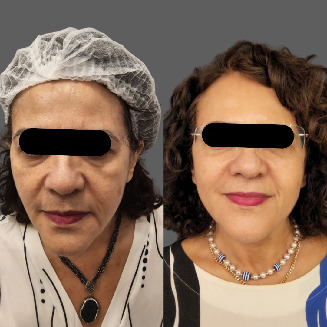 Antes e depois do protocolo VV Lift, vista frontal