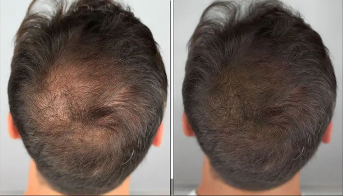 Antes e depois Revita Hair