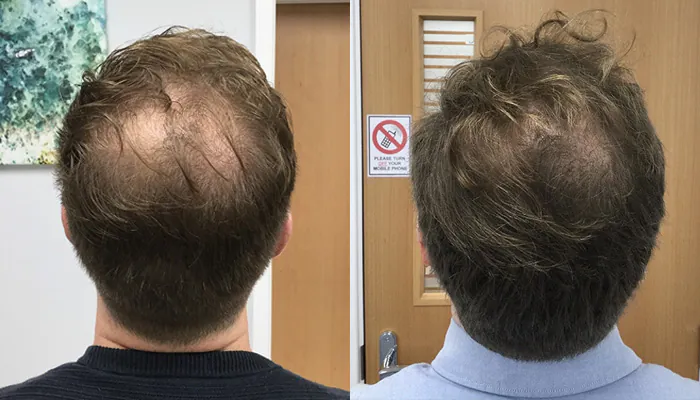 Antes e depois Revita Hair