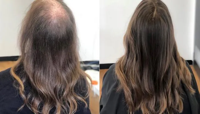 Antes e depois Revita Hair