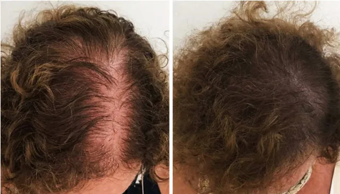 Antes e depois Revita Hair