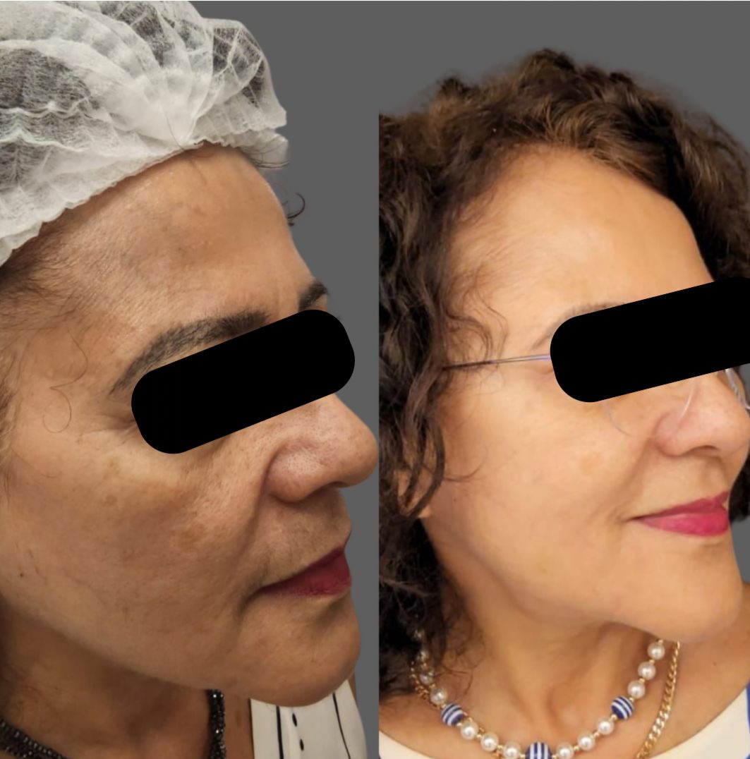 Antes e depois do protocolo VV Lift, vista de perfil